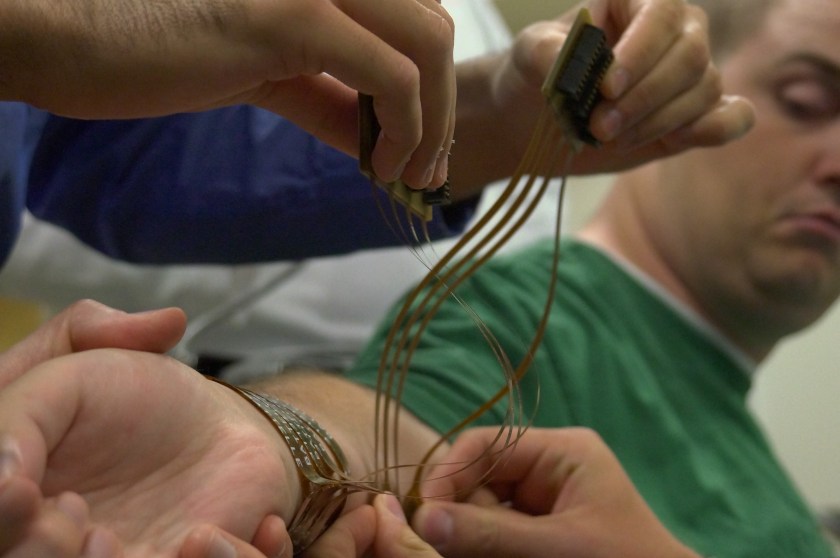 **Embargo until 12:01 AM 6/24/14** COLUMBUS, OH - JUNE 18: Ian Burkhart watches as researchers connect a sleeve of electrodes to his arm during a training session in Columbus, OH on June 18, 2014. They will relay electronic signals from a computer connected to a chip implanted in the part Burkharts brain controlling motor movement of the hand. (Photo by Lee Powell / The Washington Post via Getty Images)