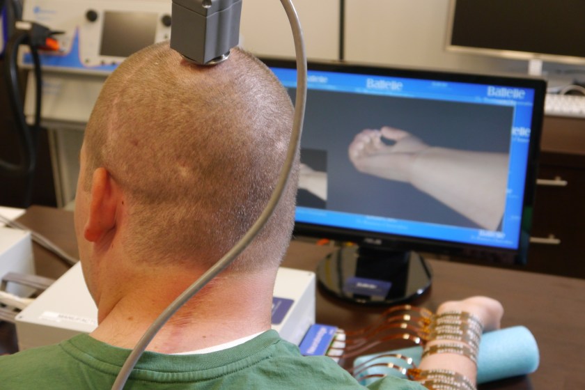 **Embargo until 12:01 AM 6/24/14** COLUMBUS, OH - JUNE 18: Ian Burkhart has a port at the top of his head where a transmitter carries signals from a chip implanted in his brain to a computer, seen here during a training session in Columbus, OH on June 18, 2014. He studies hand movement simulations on the screen that he then tries to replicate with his paralyzed hand. (Photo by Lee Powell / The Washington Post via Getty Images)