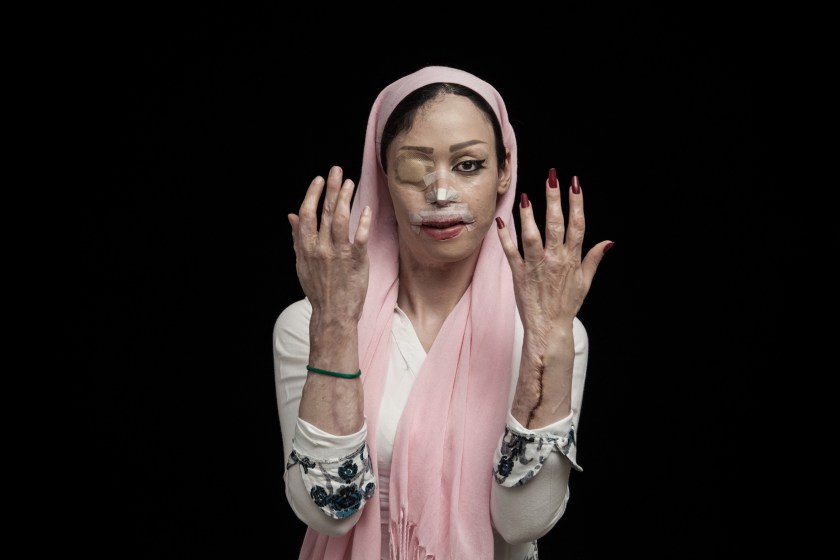 The violent act of acid throwing is primarily against women and children. These attacks are committed with the intent to disfigure, maim and destroy the social life and future of the victim. The motivation to commit this type of violence is cultural destitution, intolerance and happens in situations such as family conflicts, rejected marriage proposal, revenge and divorce requests. (Asghar Khamseh/Iran)