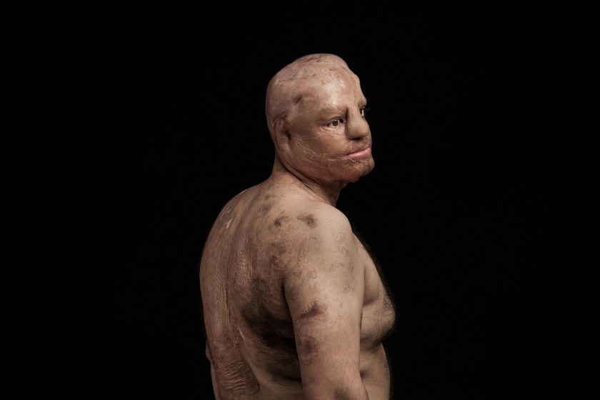 The violent act of acid throwing is primarily against women and children. These attacks are committed with the intent to disfigure, maim and destroy the social life and future of the victim. The motivation to commit this type of violence is cultural destitution, intolerance and happens in situations such as family conflicts, rejected marriage proposal, revenge and divorce requests. (Asghar Khamseh/Iran)