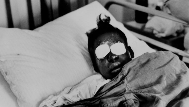 Hospitalized bomb blast victim Sarah Jean Collins, 12, blinded by dynamite explosion set off in basement of the Birmingham, Alabama church that killed her sister and three other girls as her Sunday school class was ending. (Frank Dandridge/The LIFE Images Collection/Getty Images)