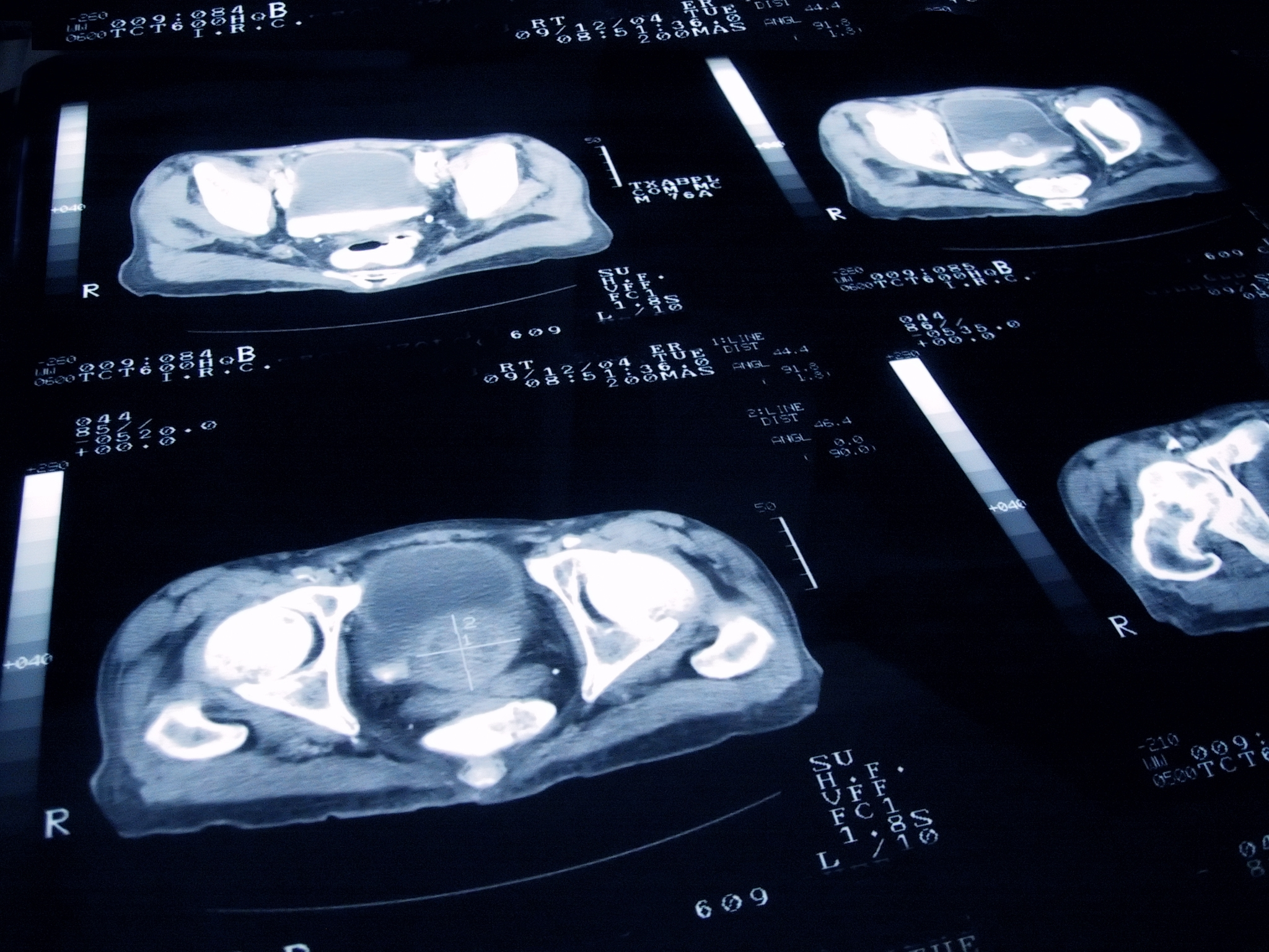 Prostate Cancer (Getty Images)