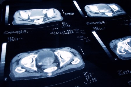 New Blood Test for Prostate Cancer Could Reduce Need for Biopsies
