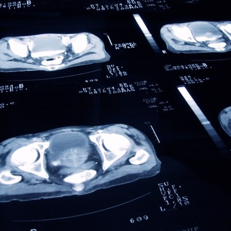 New Blood Test for Prostate Cancer Could Reduce Need for Biopsies