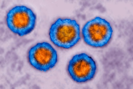 herpes