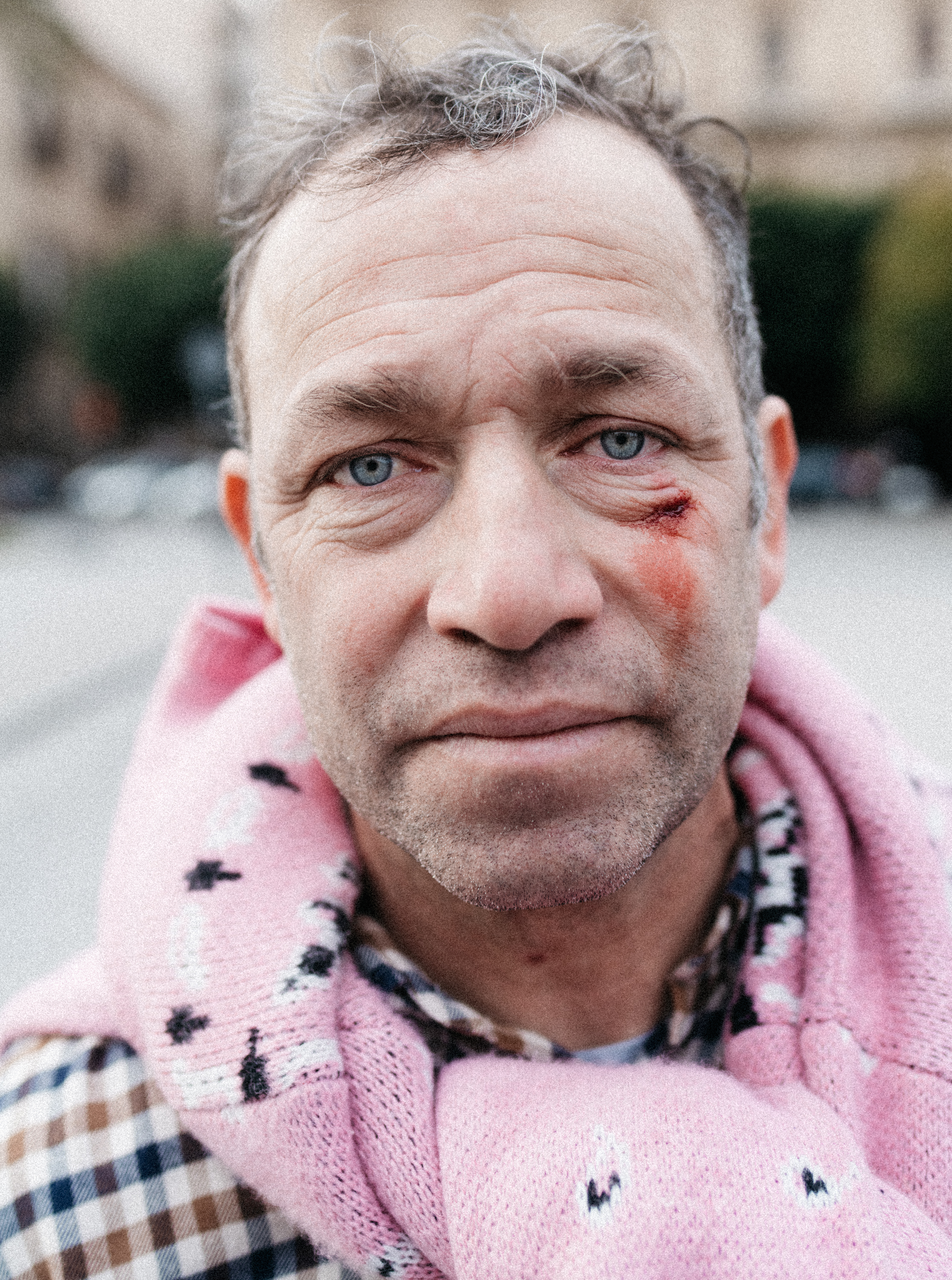 Mark Gonzales, Bleeding cheek.