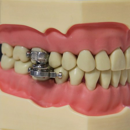 The DentalSlim Diet Control is a weight loss device that works by magnetically locking a wearer's jaw shut, preventing them from opening their mouth more than a few millimeters. Image shows the device modeled on a model jaw.