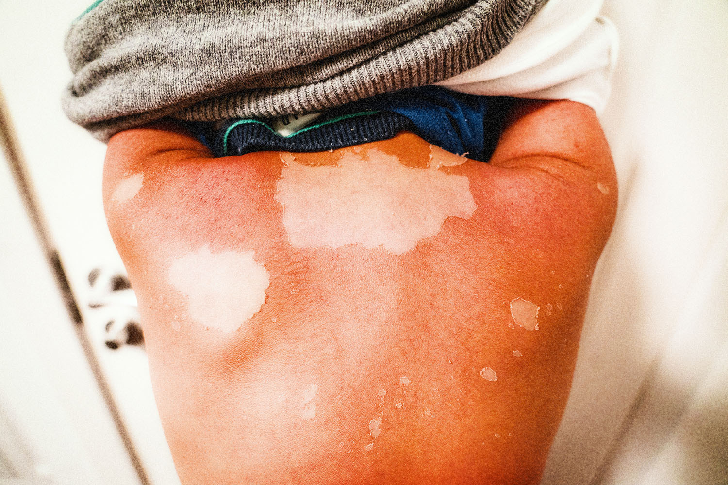 Items to help treat sunburn, according to a Dermatologist, on a green and yellow background