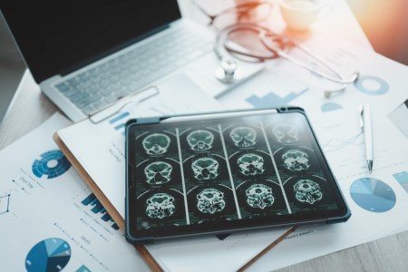 Decades-Long Brain Study Offers New Details on Dementia Risk