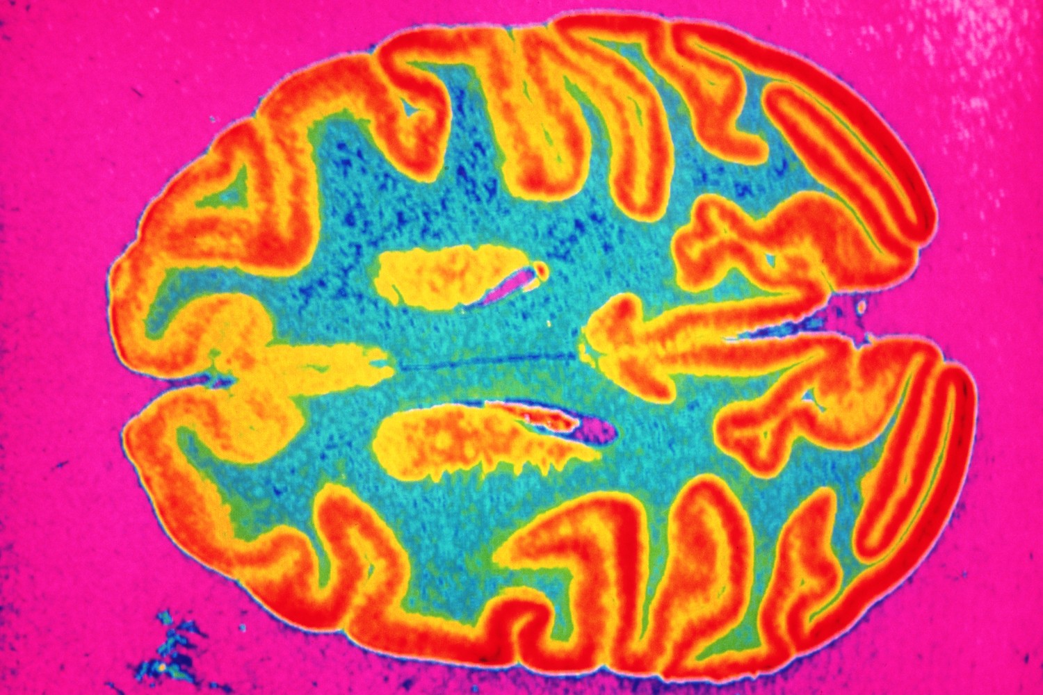 Brain scan