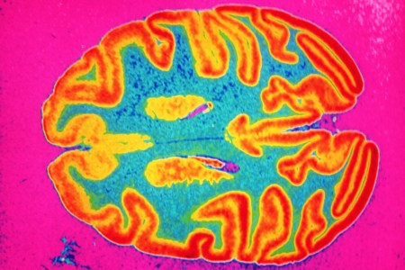 Brain scan