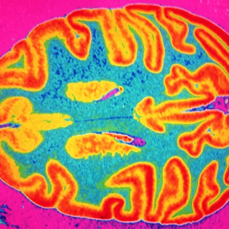 Brain scan