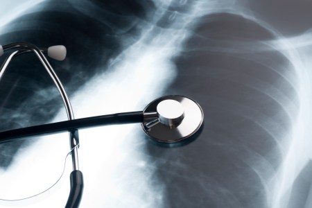 Lung x-ray
