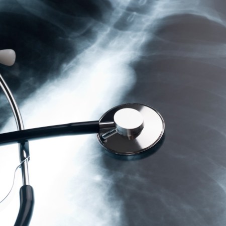 Lung x-ray