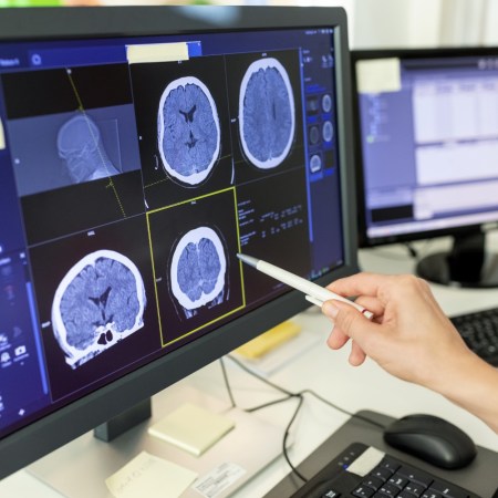 Brain scan