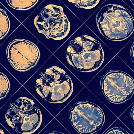 Brain scan
