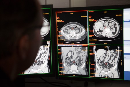 Could the Key to Understanding Long COVID Be Found in the Gut?