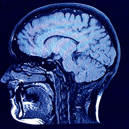 Brain scan