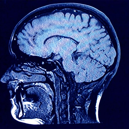 MRI scan showing brain activity. We take a look at the benefits creatine has on brain health.