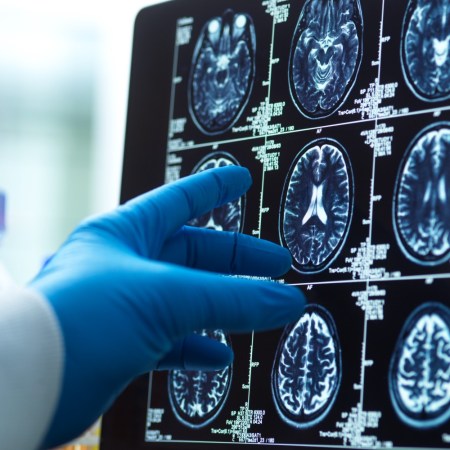 Doctor looking at brain scan
