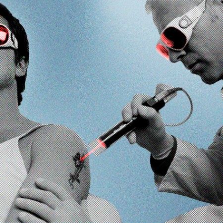 Person getting tattoo removed