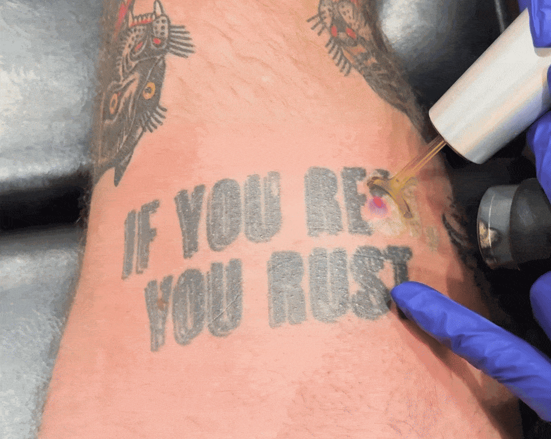 Removal of Danny's tattoo