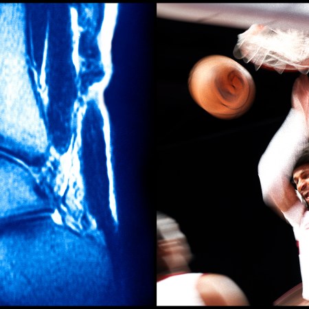 The MRI Is Too Late: A New Way to Think About Sports Injuries